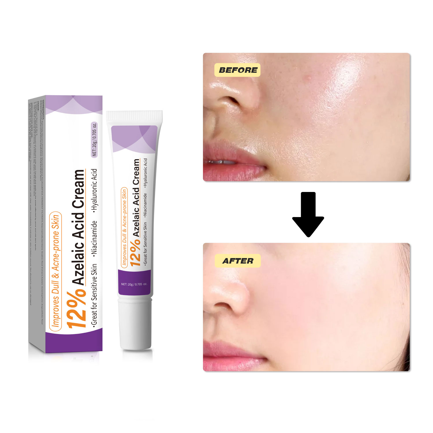 Mild Azelaic Acid Cream Improv - đánh giá và giá Azelaic Acid Cream